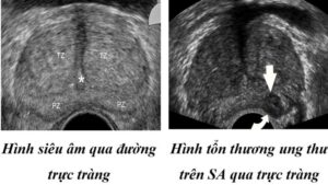 Siêu Âm Ung Thư Đà Nẵng 6 sieu am ung thu da nang